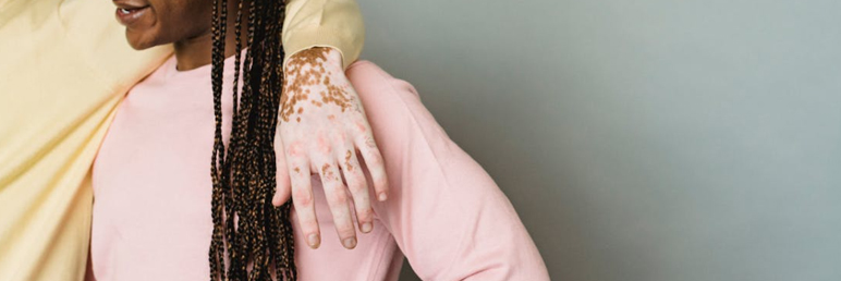 3 Setback-Causing Details in Vitiligo Management