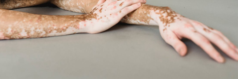 What should be noted when using 308 phototherapy at home?