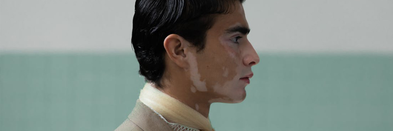 Must-Read for Vitiligo Patients: Unveiling the Truth Behind the "Incurability" of Vitiligo