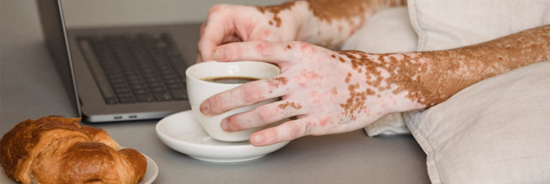 Vitiligo tends to affect these areas; be aware of these to detect abnormalities early!